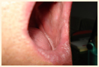 患者男，77岁a_副本.jpg