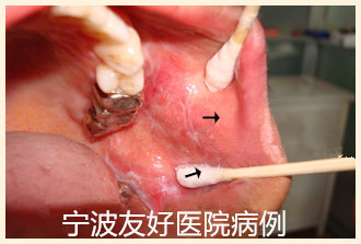 患者女，60岁治疗前.jpg