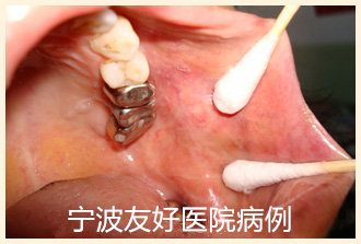 患者女，60岁治疗后.jpg