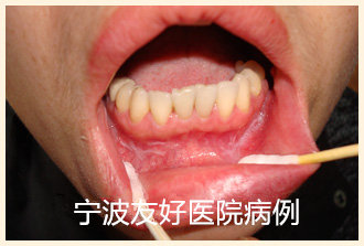 李某31岁治疗前.jpg