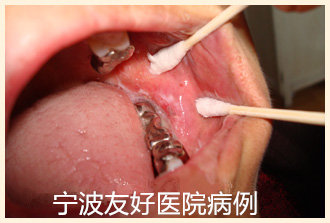 许某治疗前.jpg