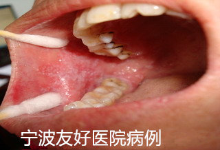 李先生右颊治疗前.jpg