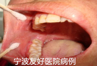 李先生右颊治疗后.jpg