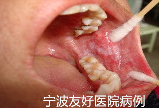 李先生左颊治疗前.jpg