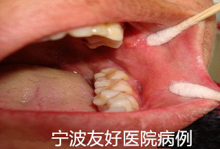 李先生左颊治疗后.jpg