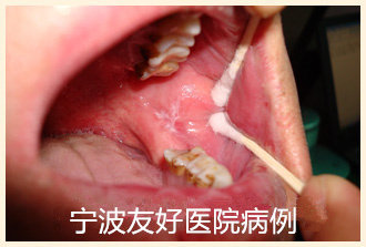 王某25岁治疗前.jpg