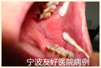 王某25岁治疗后.jpg