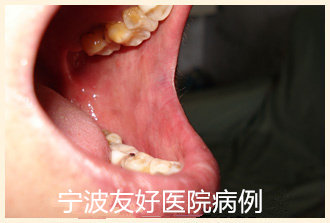 患者女，64岁治疗后.jpg