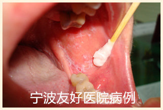 钟某治疗前.jpg