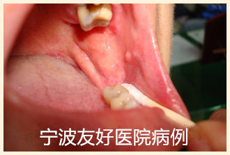 钟某治疗后.jpg