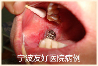张某治疗前.jpg