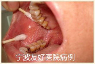 叶某治疗前.jpg
